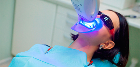 Tecnologia di sbiancamento dei denti, nonché i suoi vantaggi e svantaggi