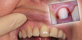 치아가 크라운 밑에 상처를 내면 어떻게해야합니까?