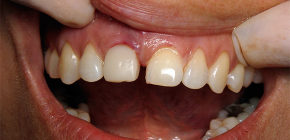 Gejala penolakan implan gigi: dengan apa tanda-tanda untuk mengenali masalah ini?
