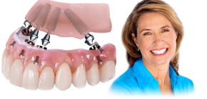 Semua-on-4 dan All-on-6 teknologi pergigian gigi: persamaan dan perbezaan
