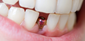 Quanto um implante dentário geralmente serve e em quanto tempo ele precisará ser substituído