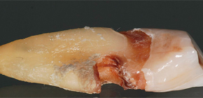 Características da cárie da raiz do dente e seu tratamento