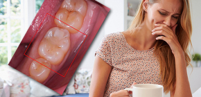 Ce trebuie să faceți dacă aveți o durere de dinți în timpul sarcinii