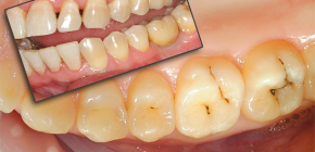 Vad händer om en tand värkar illa?
