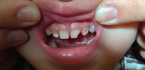 Vad ska man göra om ett barn har tandvärk: hur man dömer det?