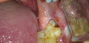 จำเป็นต้องถอดฟันภูมิปัญญาหรือทำดีกว่าเพื่อพยายามรักษาหรือไม่