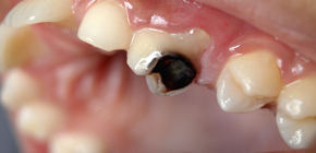 การรักษาฟันผุในปัจจุบันมีราคาเท่าไหร่และปัจจัยใดที่มีผลต่อราคา