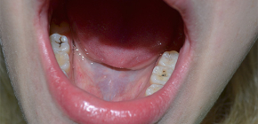 เกี่ยวกับโรคฟันผุลึก: ภาพถ่ายอาการและการวินิจฉัย