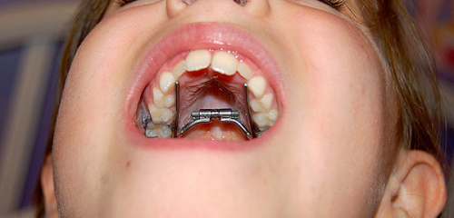 Çocuklarda ısırık düzeltmek için ortodontik cihazlar