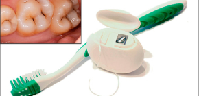 Các phương pháp hiệu quả để phòng ngừa sâu răng
