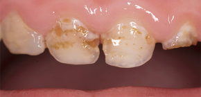 Sâu răng hàm răng ở trẻ em và điều trị của nó: điều quan trọng là cha mẹ cần biết