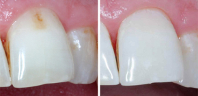Có một phương thuốc hay thuốc chữa bệnh hiệu quả cho sâu răng?