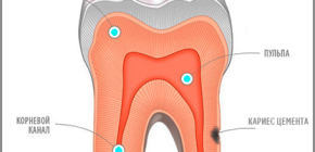 Sâu răng xi măng: từ biểu hiện lâm sàng đến phương pháp điều trị hiện đại