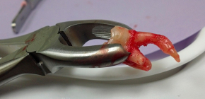 Combien coûte l’ablation d’une dent aujourd’hui: examen du prix de divers cas cliniques