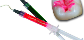 Utilisation de marqueurs de caries (indicateurs) en dentisterie