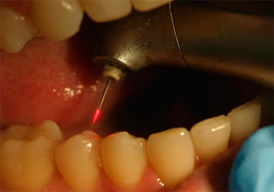 L'uso del laser nel trattamento dei denti può anche ridurre significativamente il dolore dalla procedura.