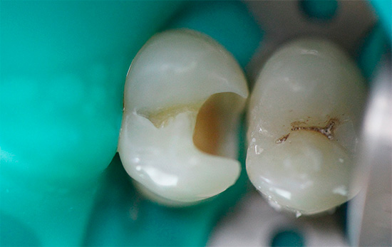 Bu gibi durumlarda, enfekte olmuş dentini ciddi bir derinliğe kadar temizlemelidir (fotoğrafta bir örnek gösterilmektedir).