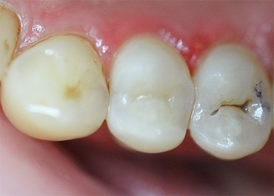 Y se parece a un diente ya sellado después del tratamiento.