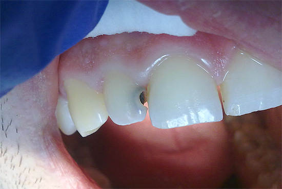 A los primeros signos de lesiones cariosas de los dientes, debe ir al dentista, no debe esperar hasta que se forme una cavidad profunda ...