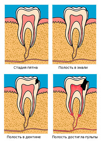 Estágios do desenvolvimento da cárie: do local do dente até a derrota da câmara pulpar.