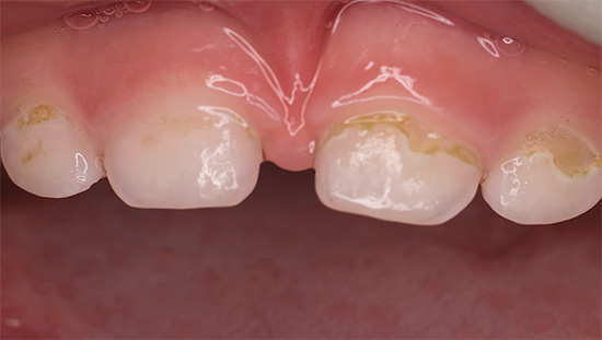 Ein charakteristisches Merkmal von Flaschenkaries ist die gleichzeitige Zerstörung mehrerer Zähne gleichzeitig.