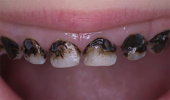 An example of teeth after silvering is shown - agree that they do not look very beautiful.