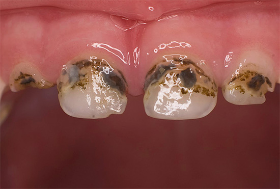 En general, se puede observar que la efectividad del procedimiento de platear los dientes para prevenir el desarrollo de caries es bastante dudosa.