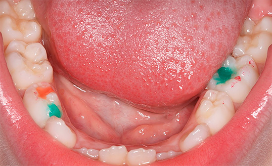 The photo shows colored fillings in a child.