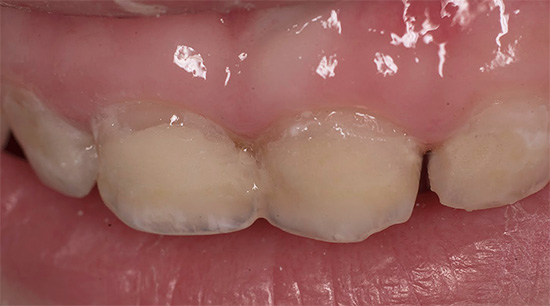Một ví dụ về sâu răng ở giai đoạn đầu phát triển