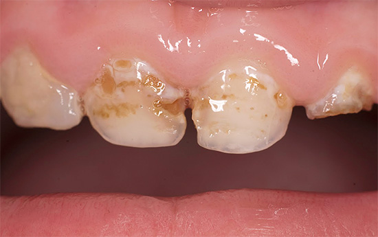 E questo è un processo carioso più profondo: lo smalto dei denti è completamente distrutto in alcuni punti.