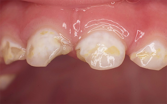 Бутилка кариес от млечни зъби преди лечението