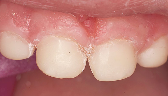Und so die gleichen Zähne, aber nach der Behandlung.