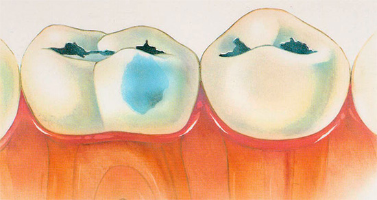 Rất nguy hiểm và thường liên quan đến các biến chứng khác nhau là quá trình sâu răng ở dạng mất bù ...