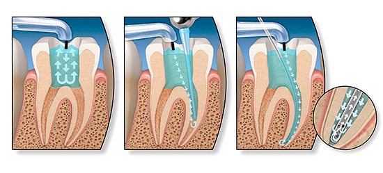 Trong điều trị các dạng sâu răng bị mất bù, nó thường là cần thiết để thực hiện depulpation (loại bỏ các dây thần kinh nha khoa)