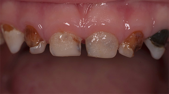 Een kenmerkend teken van de gedecompenseerde vorm van cariës is het verslaan van vele tanden tegelijk, en de mate van vernietiging kan variëren van milde tot bijna volledige afwezigheid van hard weefsel.