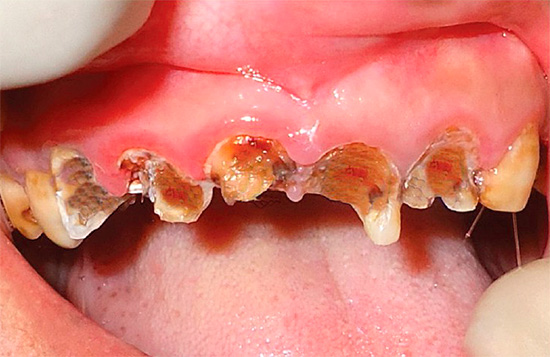 في التسوس الحاد ، يمكن أن تتدهور الأسنان بشكل خطير في غضون أسابيع قليلة.