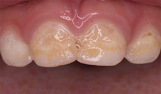Talrijke carieuze laesies van het glazuur van de tanden duiden duidelijk op een ernstig probleem en de noodzaak om zich dringend tot een tandarts te wenden.