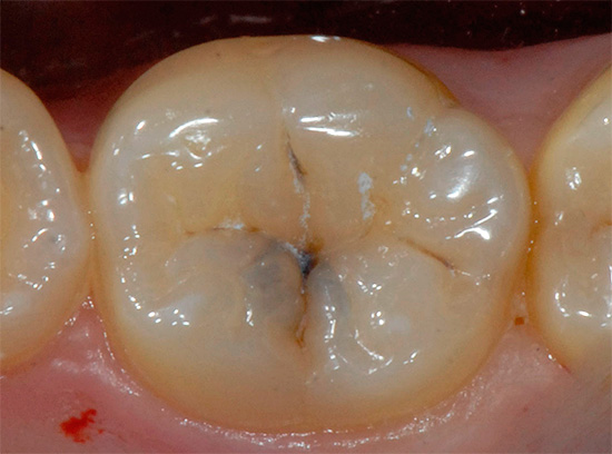 Đôi khi fissurotomy được sử dụng để ước tính độ sâu của các khoang sâu răng.