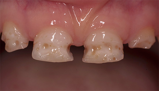 Acute caries most often develops in children with milk teeth.