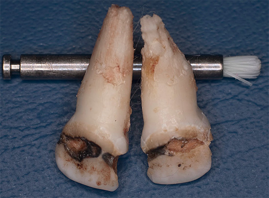 In sommige verwaarloosde gevallen kunnen afzonderlijke tanden niet langer worden opgeslagen en moeten ze worden verwijderd.