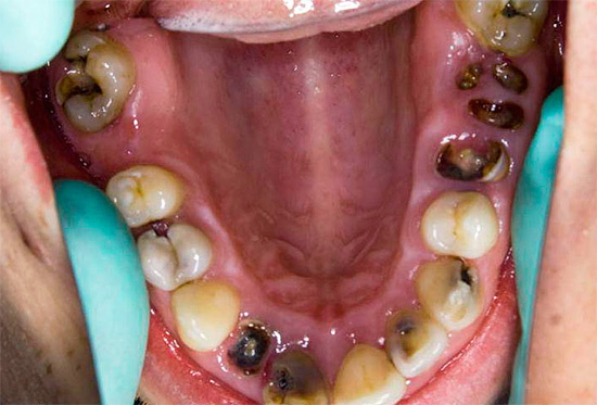The photo shows an example when almost all of the teeth are affected by caries.