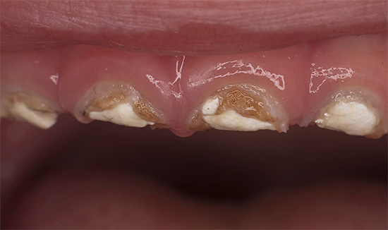 A foto mostra um exemplo de dentes de leite gravemente cariados antes da restauração.