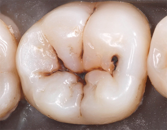Consider the characteristic features of fissure caries, including the main methods of diagnosis and treatment.