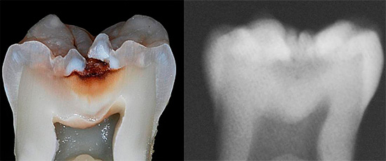 X- 선은 치아 조직이 이미 심각하게 파괴 된 나중 단계에서만 균열 영역에서 충치를 감지 할 수 있습니다.