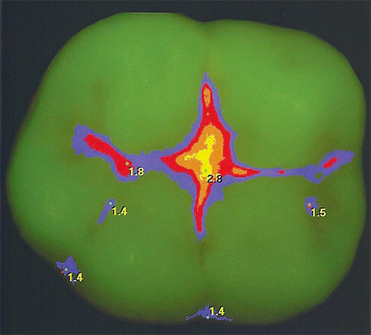 Een van de zeer effectieve moderne methoden voor het detecteren van fissuurcariës is laserdiagnostiek.