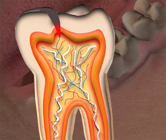Wenn Fissurenkaries die Pulpakammer erreicht hat, ist in den meisten Fällen eine Entfernung des Zahnnervs erforderlich.