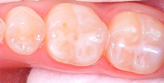 La foto muestra dientes con fisuras selladas.