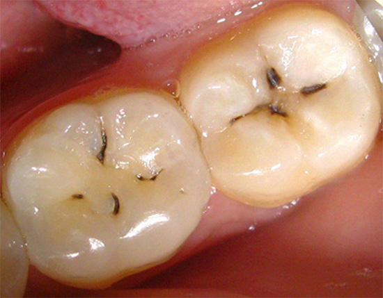 An example of fissure caries