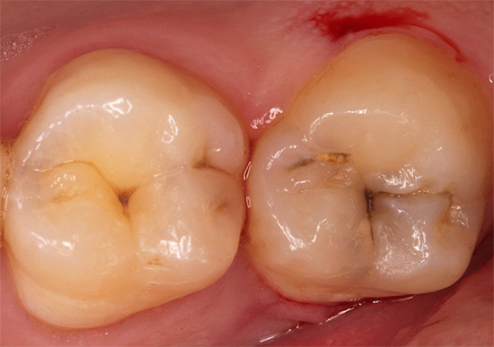 A cárie de fissura está localizada principalmente na parte central do dente, embora muitas vezes haja exceções.