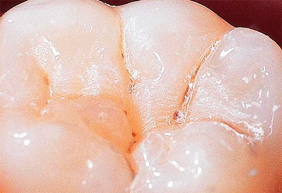 In den meisten Fällen entwickelt sich Fissurenkaries asymptomatisch, obwohl man im Spiegel bereits die dunklen Bereiche auf den Zähnen sieht.